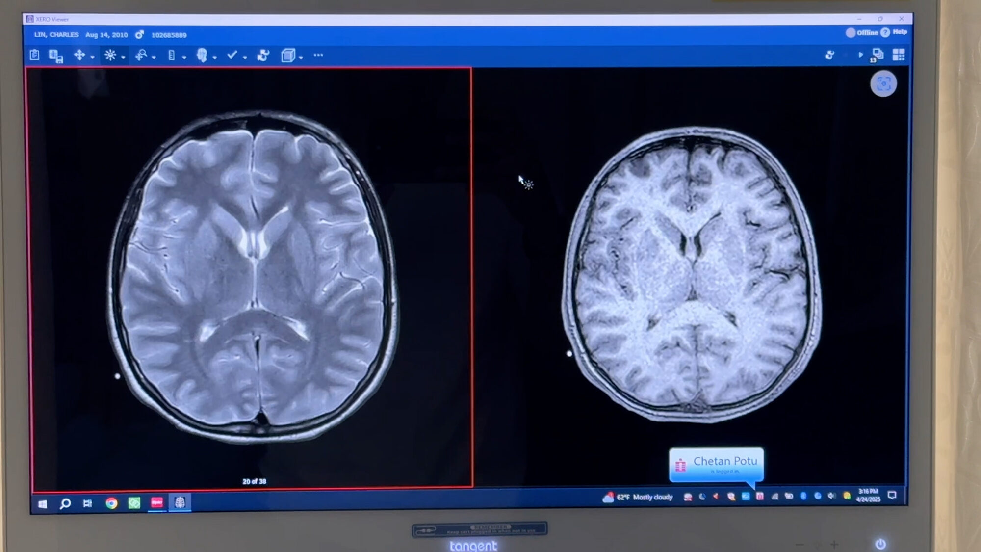 Charlie's brain imaging on a clinical monitor